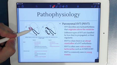 ECG of the Week: PSVT - YouTube