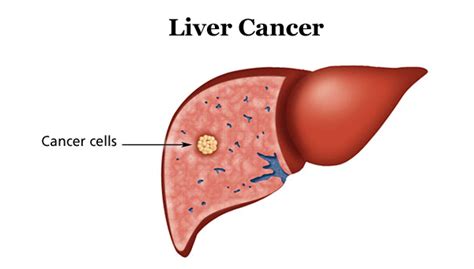 Why and When to do Liver Cancer Test