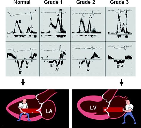 Established and Novel Clinical Applications of Diastolic Function Assessment by Echocardiography ...