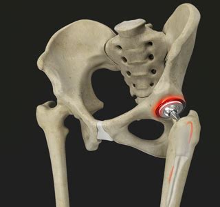 Periprosthetic Hip Infection Grand Junction CO | Mesa County Hip Pain