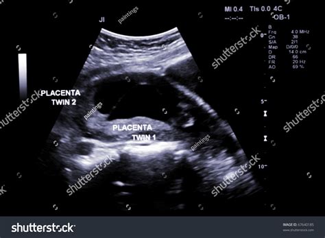 First Trimester Ultrasound Baby Xray Fraternal Stock Photo 67640185 ...