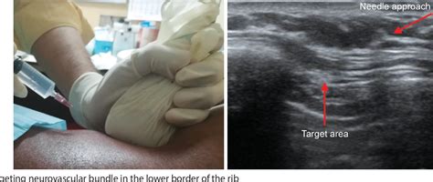 Ultrasound-guided Intercostal Nerve Block in Chronic Musculoskeletal Chest Pain: A Case Report ...