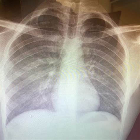 (PDF) Negative Pressure Pulmonary Edema: A Case Report