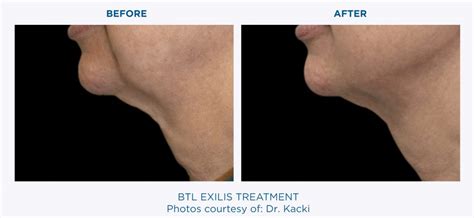 Skin Tightening With BTL EXILIS Ultra | Beverly Hills | Los Angeles ...