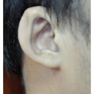 Mild dysmorphic facial features of this patient including (a) prominent... | Download Scientific ...