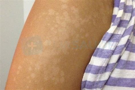 White Spots On Skin: 7 Causes & How To Get Rid of Them - Tua Saúde