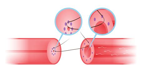 Advanced Micro-surgical Vasectomy Reversal by Multilayer Microdot Method » Tees Urology