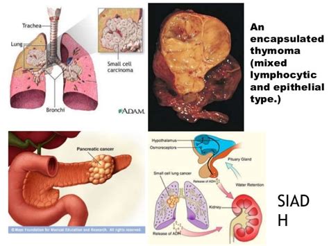 Paraneoplastic syndrome