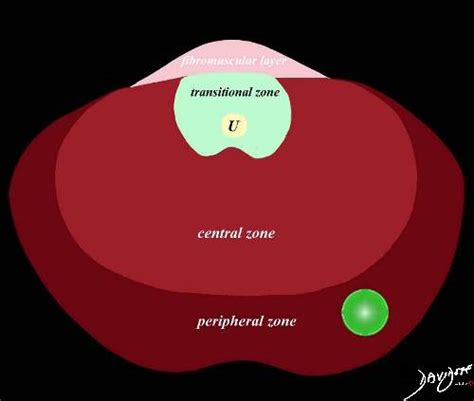 Prostate cancer in the peripheral zone - ART IN ANATOMY