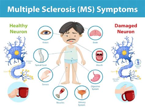 Multiple Sclerosis: Double Vision And Other Warning Signs In The Eyes | TheHealthSite.com