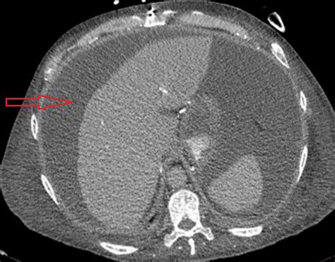 Nephrogenic Ascites: An Unusual Culprit of Refractory Ascites in a ...