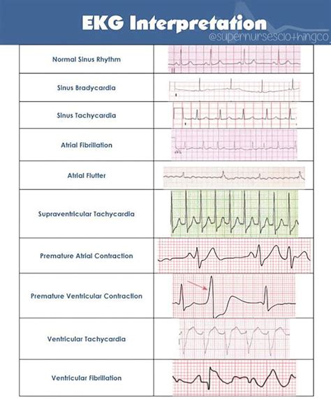 EKG Interpretation | Nurse, Nursing school survival, Nursing school tips