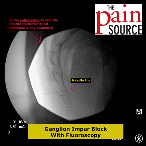 Ganglion Impar Block with Fluoroscopy - The Pain Source - Makes Learning About Pain, Painless