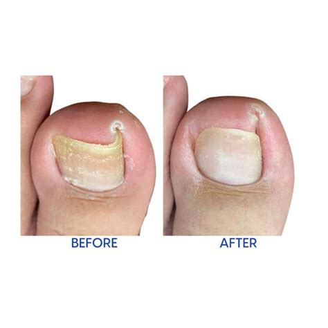 Relief Now Ingrown Toenail Pain Reliever | Support Plus