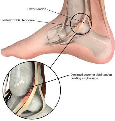 Posterior Tibial Tendon Insertion