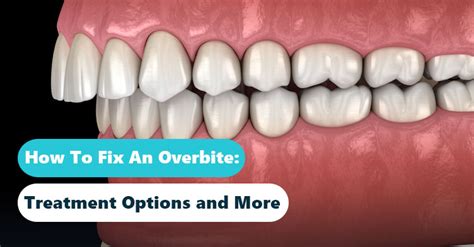 Overbite Correction: How to Fix an Overbite Fast and Safely