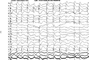 Landau-Kleffner syndrome (LKS) – WeHeal.org