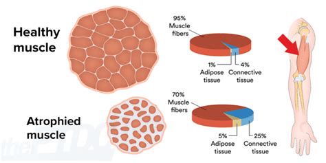 How to Fight Muscle Atrophy After Injury: A Personal Trainer’s Guide