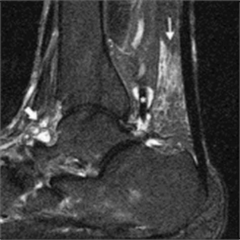 MRI Musculo-Skeletal Section: Achilles peri tendonitis - MRI