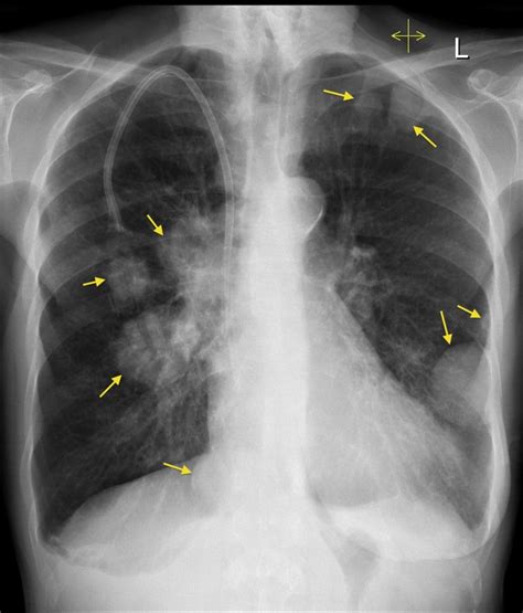 The Breast Cancer Survivor: Breast Cancer Metastasis To Spine