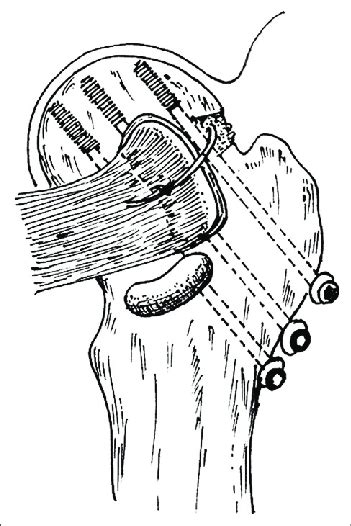 Schematic diagram showing that after placement of the muscle pedicle... | Download Scientific ...