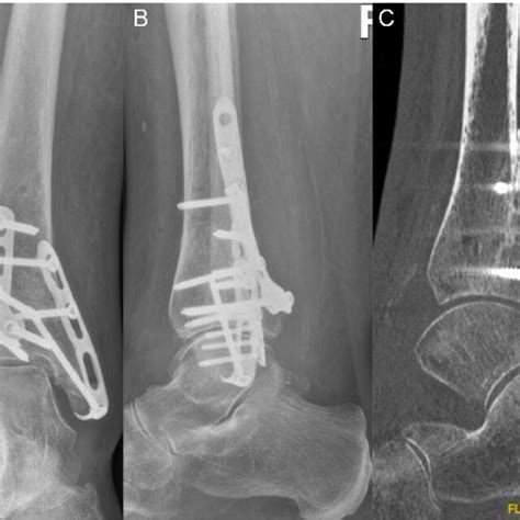 (A, B) X-ray 3 months after ORIF of PM with 3.5 mm T-Plate, ORIF fibula... | Download Scientific ...