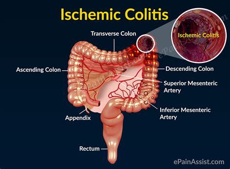 What Causes Ischemic Colitis: Know its Symptoms, Pathophysiology, Etiology