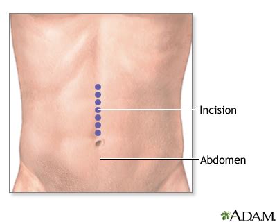 Small bowel resection - series—Incision: MedlinePlus Medical Encyclopedia