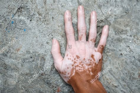 Fingers with vitiligo, Vitiligo is a disease that causes loss of skin ...