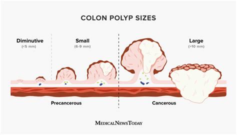 Colon polyp size chart: How doctors classify polyps