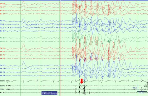 Epilepsy with myoclonic–atonic seizures (Doose syndrome): When video-EEG polygraphy holds the ...