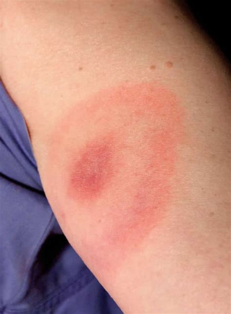 Bullseye rash last year- lyme or not lyme disease?