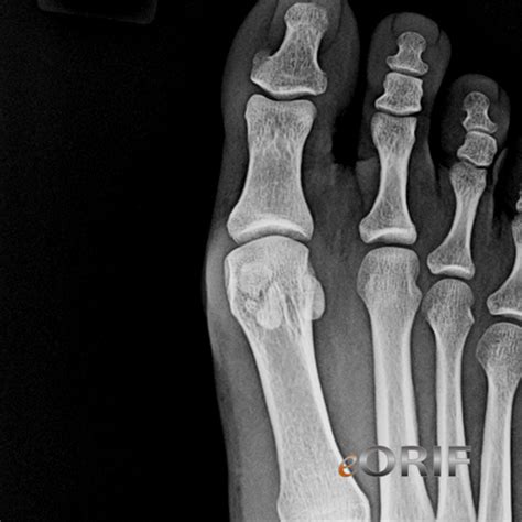 Sesamoid Pain / Fracture M25.879 733.99 | eORIF