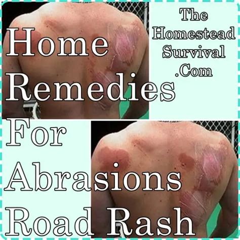 Home Remedies For Abrasions Road Rash - The Homestead Survival