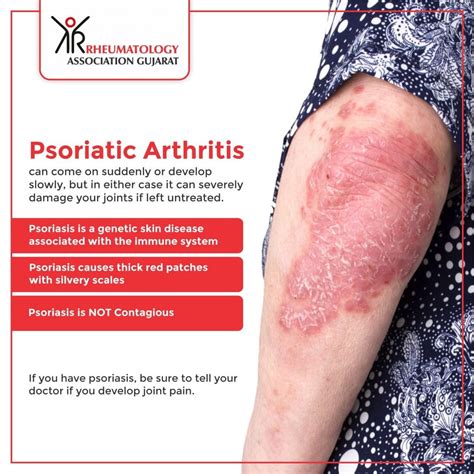 How Does Psoriatic Arthritis Start - ArthritisDaily.net