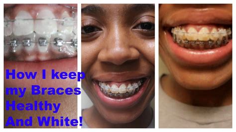 How To Keep Ceramic Braces White - Sinkforce15