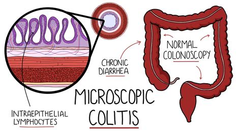 Microscopic Colitis (Lymphocytic & Collagenous Colitis) - An Underdiagnosed Form of IBD - YouTube