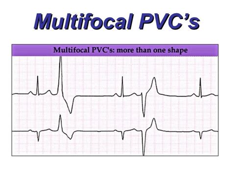 Ventricular Rhythms - BMH/Tele