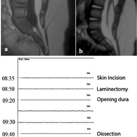 Sagittal (a) and axial (b) T1W MR images showing a lipomyelomeningocele... | Download Scientific ...