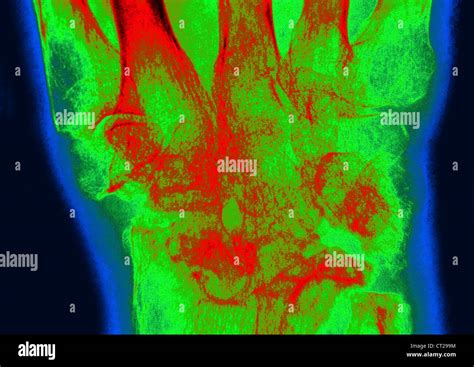RHEUMATOID ARTHRITIS, X-RAY Stock Photo - Alamy