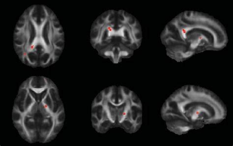 Mean fractional anisotropy (FA) images in axial, coronal and sagittal... | Download Scientific ...