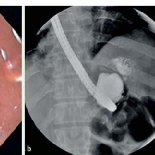 Giant chronic gastrogastric fistula following gastric bypass. a... | Download Scientific Diagram