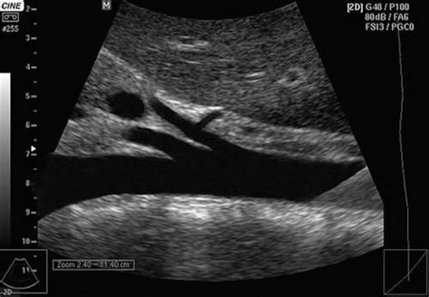 Abdominal Aorta Ultrasound | K & T Diagnostic, Inc.