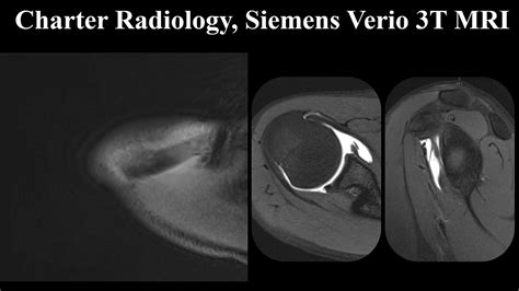 MRI Arthrogram of the Shoulder - YouTube