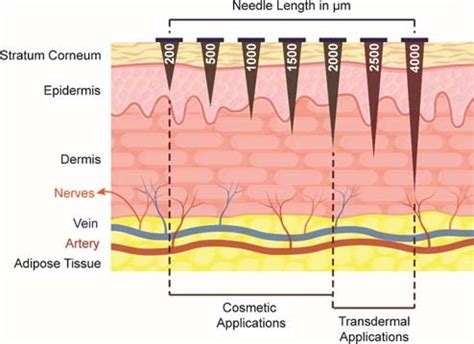 Variations of the needle length in derma rollers and their application ...