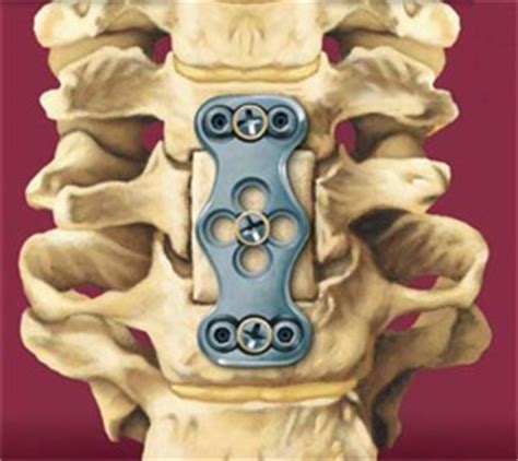 Corpectomy - The Spine MD