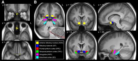 Olfactory Nerve Mri