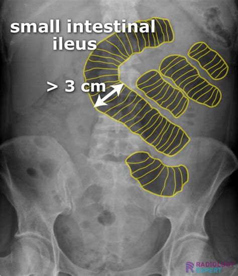 Abdominal X-ray