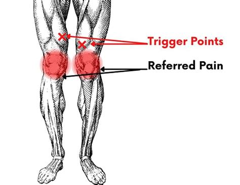 How to Recover from Quadriceps Injury (Pain Above the Knee) – Facts & Physio