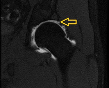 Mri Arthrogram Shoulder Labral Tear